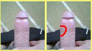 The_Straight_Pointing_Penis_Analysis_05-PenisDiscolorationArea